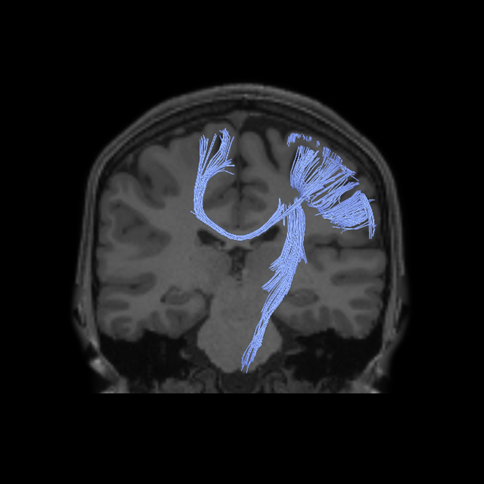 3b_dti